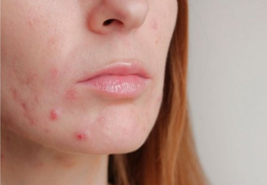 Say Goodbye to Acne: Your Ultimate Guide for Clear Skin